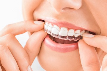 Discreet trays make Invisalign treatment a lot less obvious