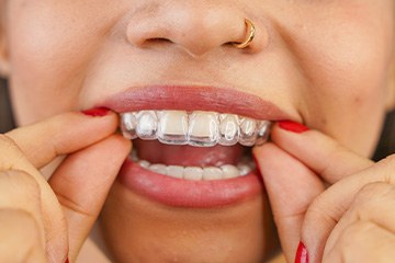 Wire free Invisalign is much more comfortable than traditional braces