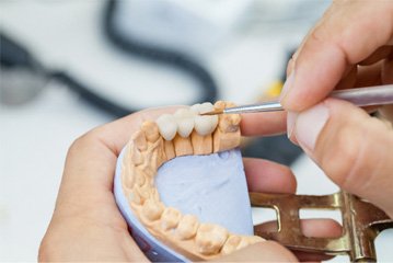 Dental bridge in Tustin