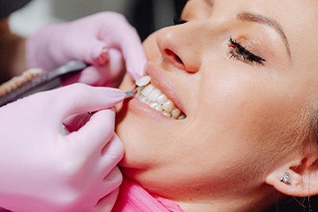 Gloved hands holding veneer by woman’s tooth