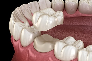 example of the process for dental crowns in Tustin