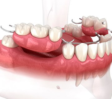 Illustration of partial dentures for lower arch