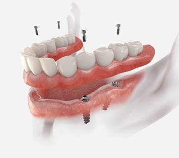 Illustration of implant denture for lower jaw