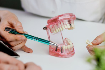 Dentist pointing at a dental implant model
