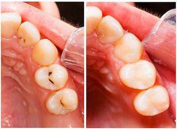 Smile before and after tooth colored fillings