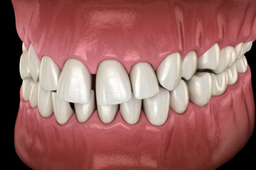 Illustration of gapped teeth