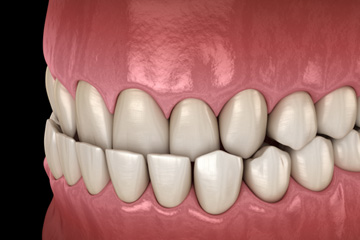 Illustration of an underbite