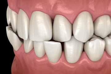 Illustration of a crossbite