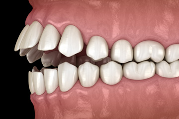 Illustration of an open bite
