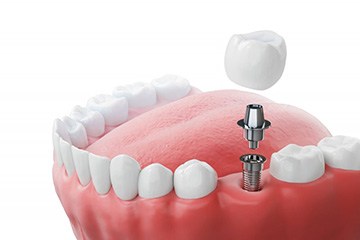 a 3D illustration of a single dental implant