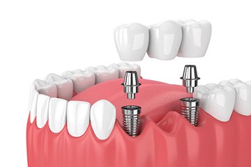 a 3D illustration of a dental implant bridge