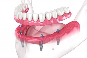 a 3D illustration of an implant denture