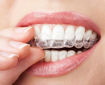 Person placing Invisalign tray