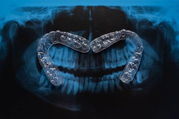 Invisalign trays on top of dental x-rays