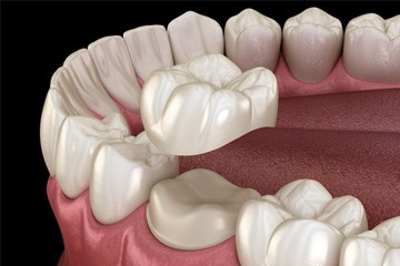 Illustration of dental crown being placed on lower tooth