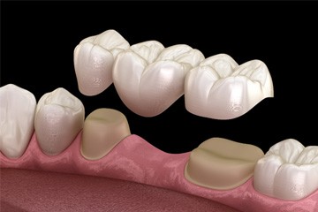 Illustration of dental bridge