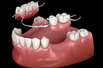 Illustration of partial denture