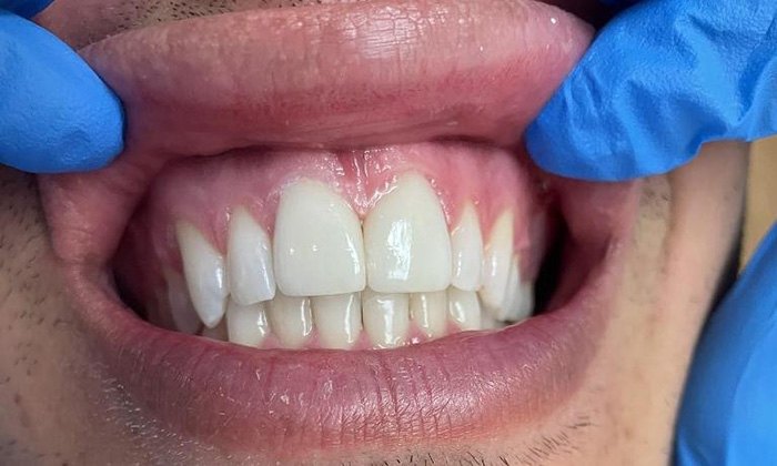 Smile with broken tooth seamlessly repaired