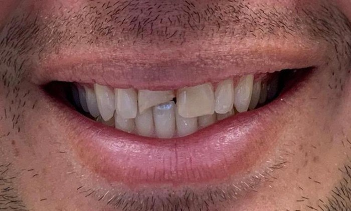 Smile with broken top front tooth