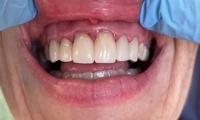 smile case 2 after photo
