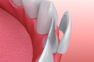 Illustration of veneer in Tustin