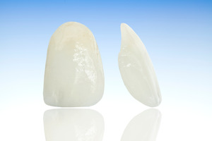 Close-up of two veneers on a blue background