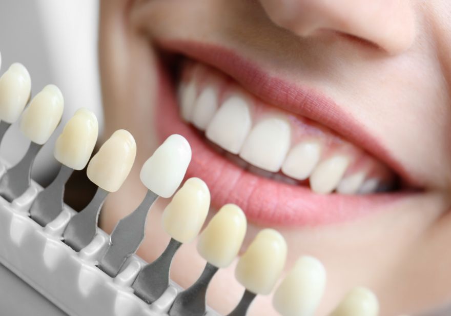 Women smiling with teeth whitening options