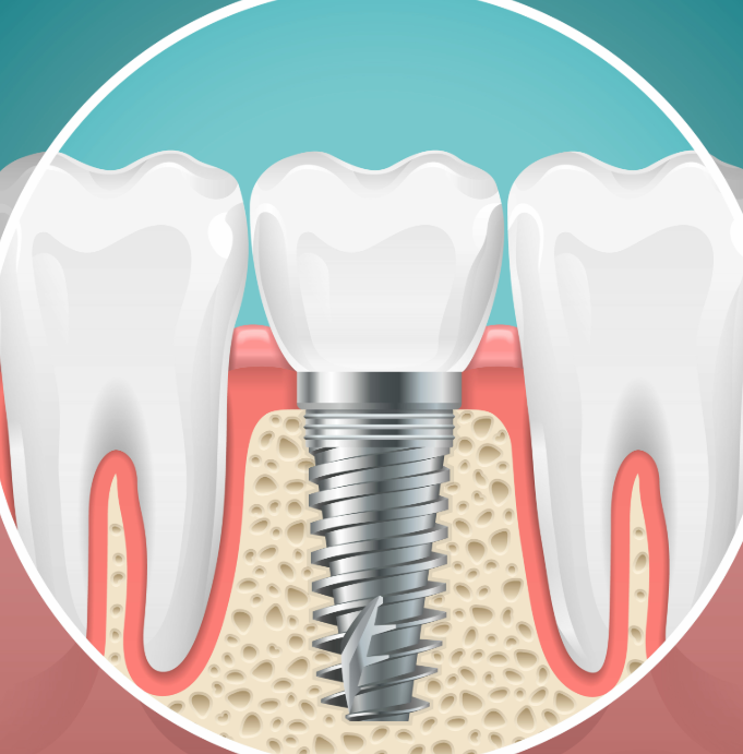 Illustrated cross section of a dental implant